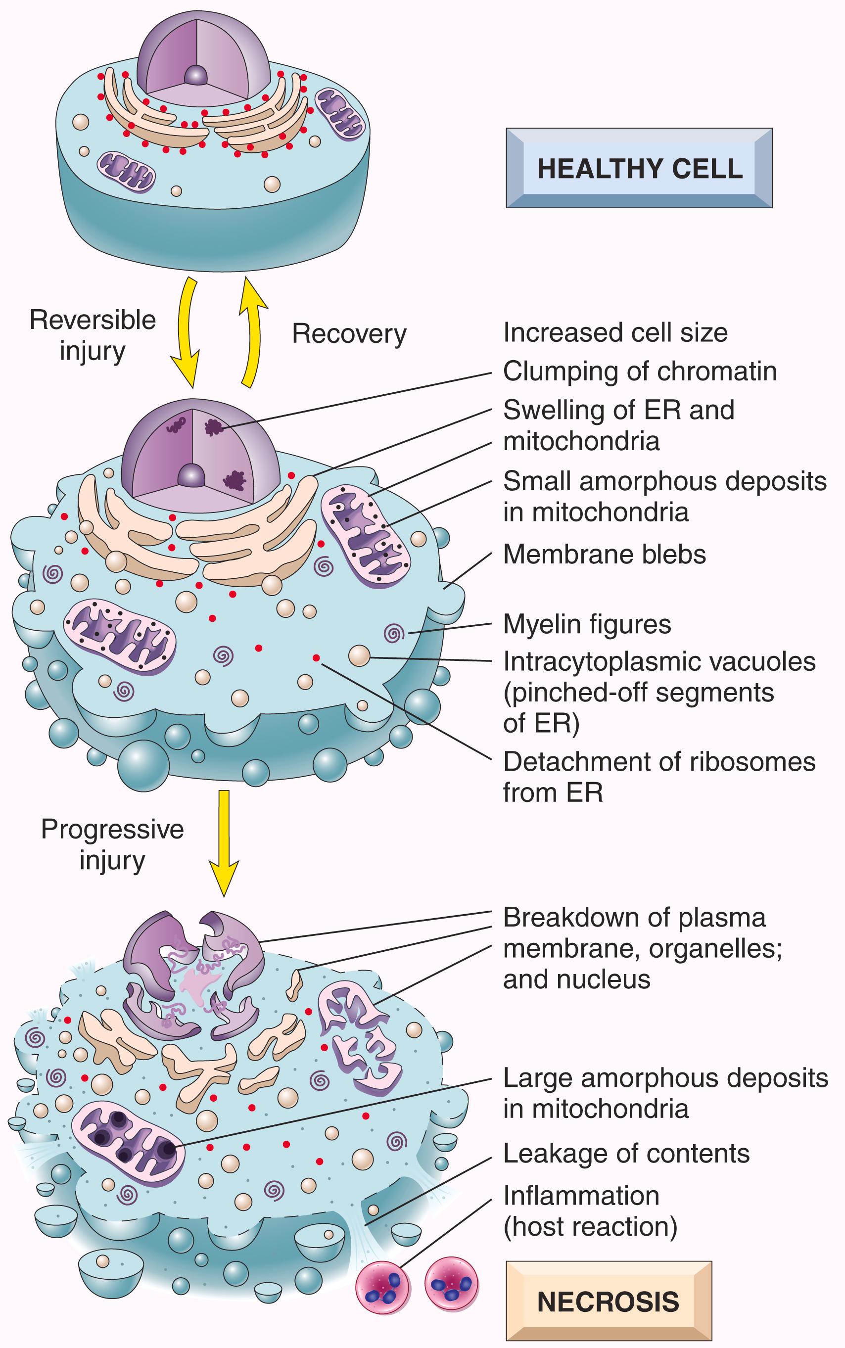 FIG. 1.3, Reversible cell injury and necrosis. The principal cellular alterations that characterize reversible cell injury and necrosis are illustrated. If an injurious stimulus is not removed, reversible injury culminates in necrosis.