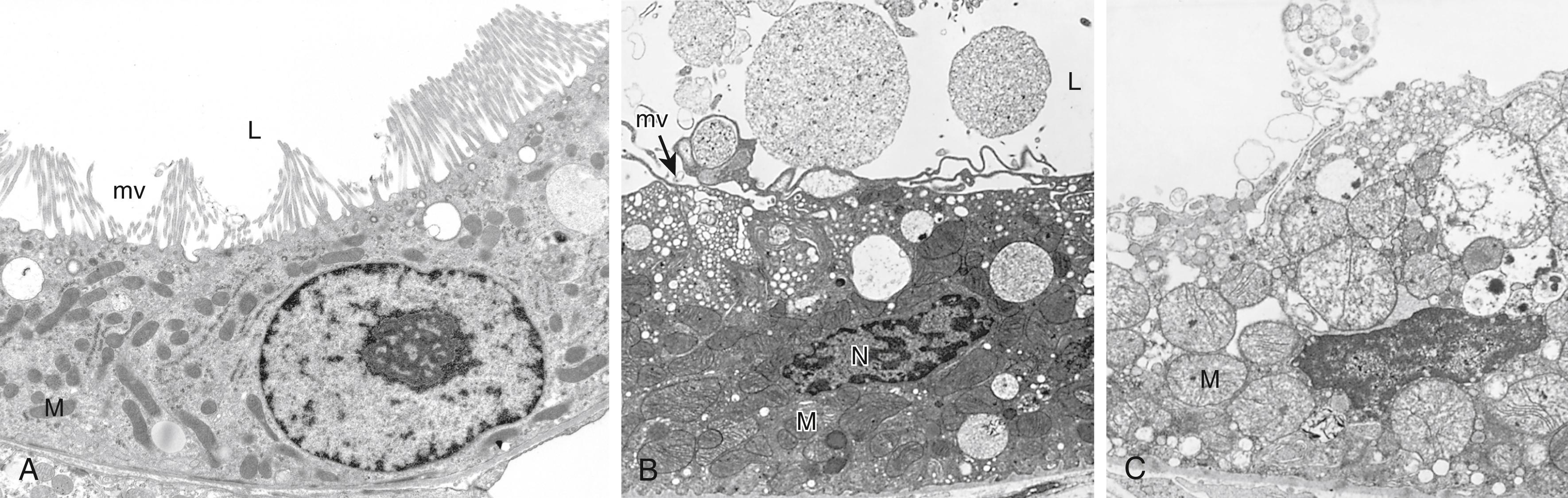 eFIG. 1.1, Ultrastructural features of reversible and irreversible cell injury (necrosis) in a rabbit kidney. (A) Electron micrograph of a normal epithelial cell of the proximal kidney tubule. Note abundant microvilli (mv) lining the luminal surface (L) . (B) Epithelial cell of the proximal tubule showing early cell injury resulting from reperfusion following ischemia. The microvilli are lost and have been incorporated in apical cytoplasm; blebs have formed and are extruded in the lumen. Mitochondria (M) would have been swollen during ischemia; with reperfusion, they rapidly undergo condensation and become electron dense. (C) Proximal tubular cell showing late injury, expected to be irreversible. Note the markedly swollen mitochondria containing electron-dense deposits that contain precipitated calcium and proteins. Higher magnification micrographs of the cell would show disrupted plasma membrane and swelling and fragmentation of organelles. N , Nucleus.