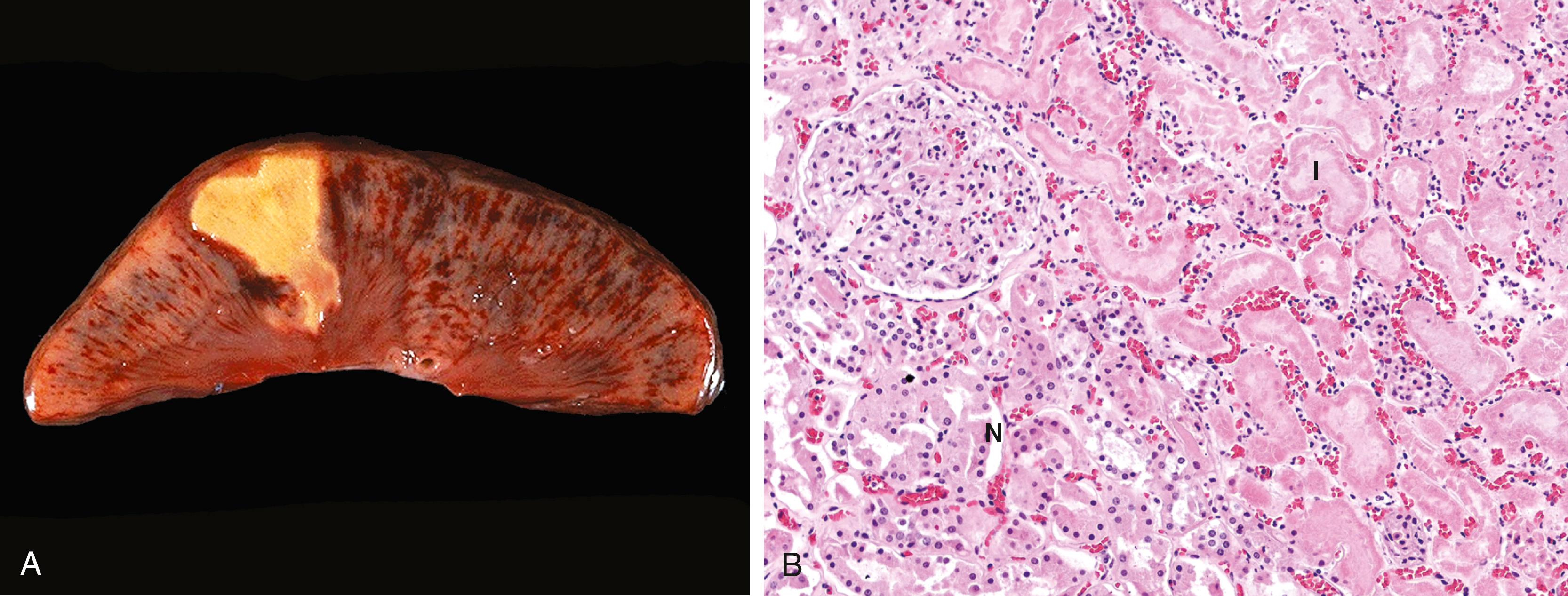 FIG. 1.6, Coagulative necrosis. (A) A wedge-shaped kidney infarct (yellow) with distinct margins. (B) Microscopic view of the edge of the infarct, with normal kidney (N) and necrotic cells in the infarct (I) . The necrotic cells show preserved outlines with loss of nuclei, and an inflammatory infiltrate is present (difficult to discern at this magnification).