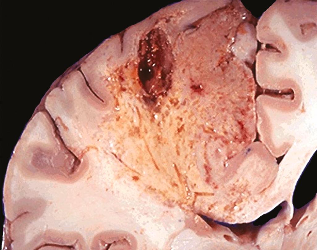 FIG. 1.7, Liquefactive necrosis. An infarct in the brain showing dissolution of the tissue.