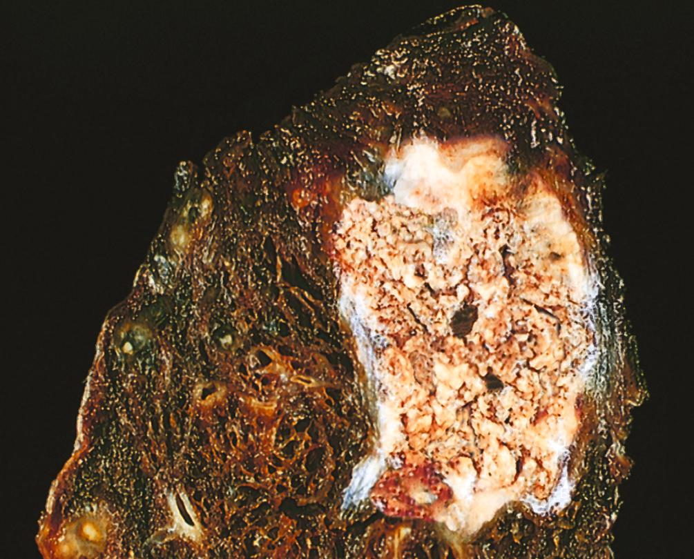 FIG. 1.8, Caseous necrosis. Tuberculosis of the lung, with a large area of caseous necrosis containing yellow-white (cheesy) debris.