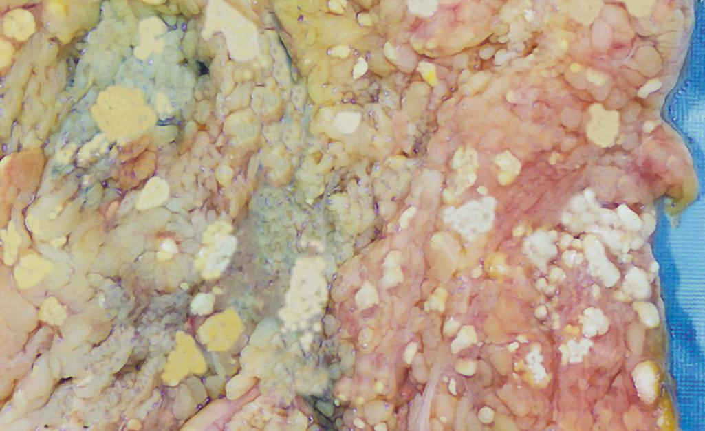 FIG. 1.9, Fat necrosis in acute pancreatitis. The areas of white chalky deposits represent foci of fat necrosis with calcium soap formation (saponification) at sites of lipid breakdown in the mesentery.