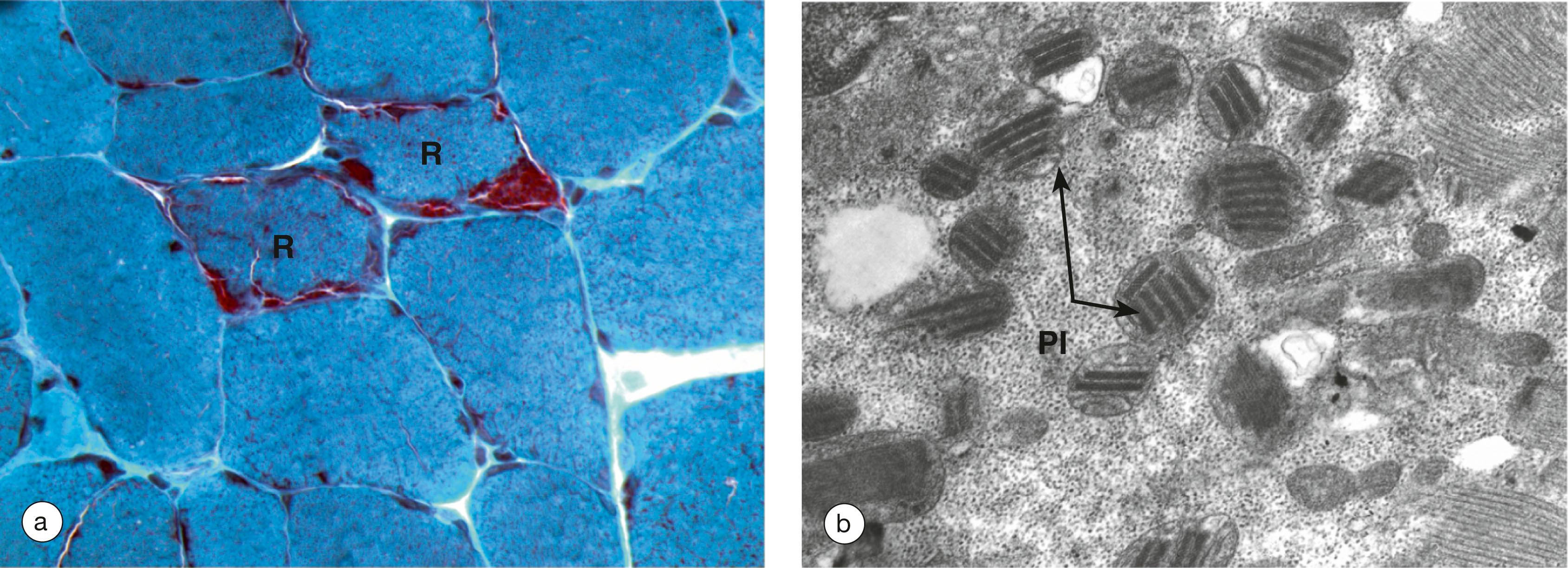 E-Fig. 2.1, Mitochondrial myopathy.