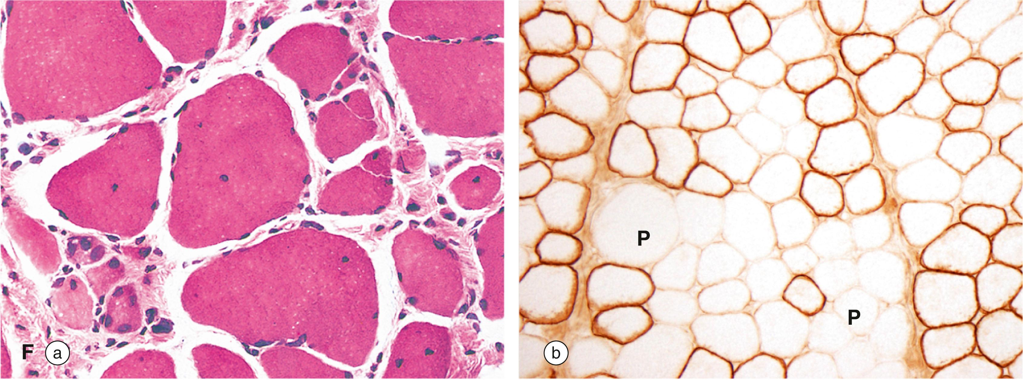 E-Fig. 1.2, Muscular dystrophy.