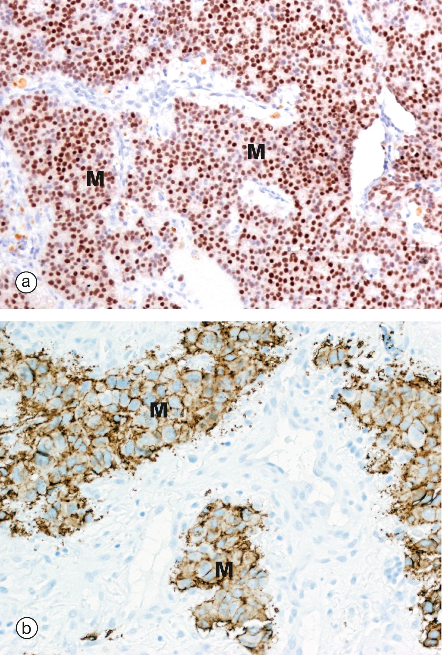 E-Fig. 1.1, Predictive tests in breast carcinoma.