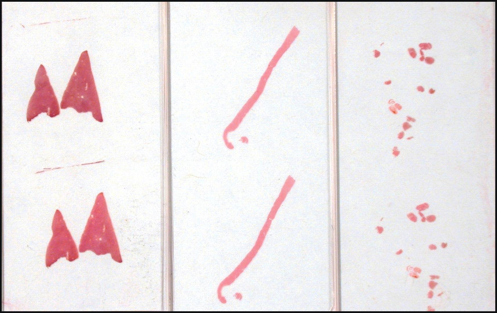 Figure 2.1, Different types of liver biopsy provide liver tissue of various sizes and shapes. Left to right, wedge biopsy, percutaneous biopsy, transvenous liver biopsy.