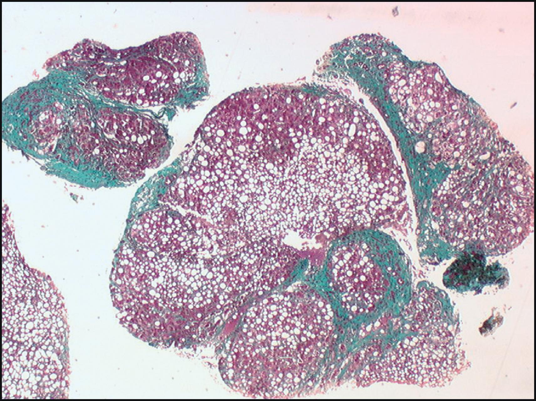 Figure 2.2, Transvenous liver biopsy of cirrhotic patient. Although the biopsy sample is small and fragmented, the diagnosis of cirrhosis is obvious with annular fibrosis in a liver with steatosis (Masson trichrome stain).