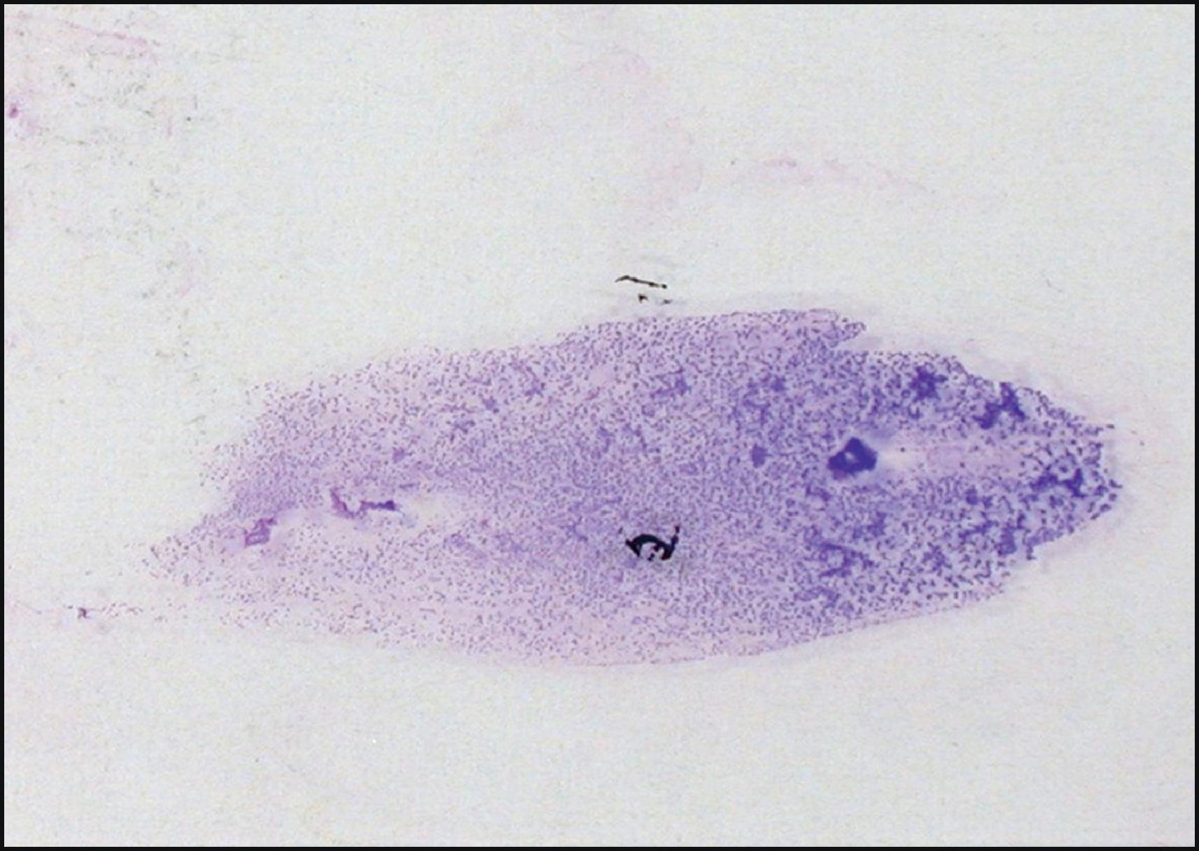 Figure 2.3, Smear from an ultrasound-guided fine-needle aspiration spread on a glass slide and stained with Diff-Quik.