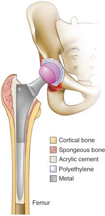 Fig. 63.1, Illustration of cemented total hip arthroplasty.