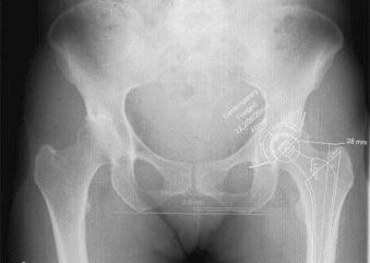 Fig. 63.2, Templating for cemented total hip arthroplasty.