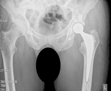 Fig. 65.1, A cemented femoral component can reliably reproduce the biomechanics of the hip because femoral offset, leg length, and version all are independently variable.