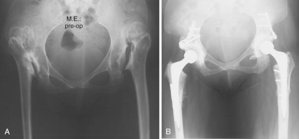 Fig. 65.2, (A) and (B), Cemented femoral components can be used for any pathology. In the case illustrated, subtrochanteric femoral osteotomies have been necessary in the treatment of bilateral Crowe IV developmental dysplasia of the hip.