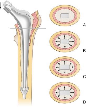 Fig. 65.4, Transverse sections at the level of the line on the femur. (A) The unloaded situation. (B) On loading, radial compressive stresses are induced in the cement. (C) As the stem has subsided, a larger cross-section is accommodated by the cement, generating hoop tensile stresses within the cement mantle. (D) On resting, residual hoop strain persists, and stress relaxation occurs within the cement of these tensile forces. The loading regimen is now dominated by compression at the stem-cement interface, within the cement, and across the cement-bone interface.