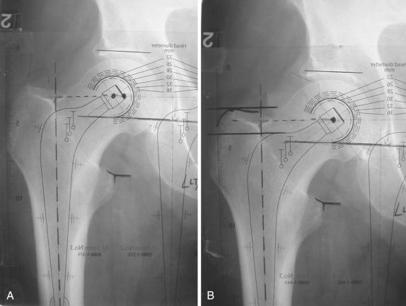 Fig. 65.5, (A) A template of a femoral component of insufficient offset has been laid on the radiograph. (B) A femoral component with a greater offset is chosen, and it now can be seen that the center of rotation of the prosthesis coincides with that of the native hip. Leg length is unchanged.