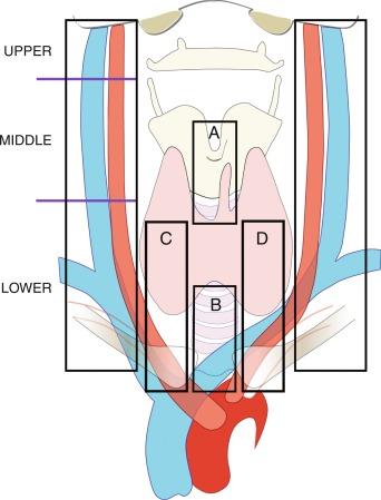 Fig. 38.1, The four major regions that constitute most important nodal-bearing regions within the central neck include prelaryngeal (Delphian) ( A ), pretracheal ( C ), and bilateral paratracheal ( B and D ).
