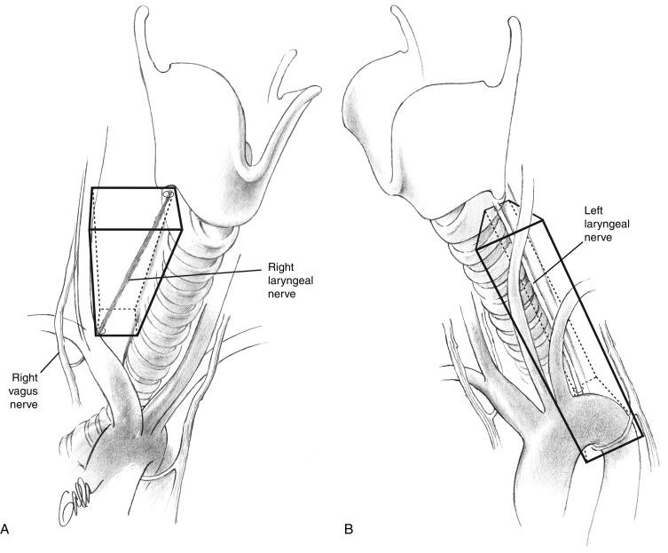 Fig. 38.2, Varying anatomy of the left versus right paratracheal regions. The nodal compartment on the left (A) has greater depth because the nerve enters more ventral underneath the bifurcating innominate artery, which lies ventral to the trachea. The right nerve then extends medially and descends to its laryngeal entry point at the right lateral inferior edge of the cricoid cartilage. The right paratracheal region can be divided into two triangles: an upper lateral triangle and a lower medial triangle. The nerve divides the compartment into an anterior and posterior compartment, and nodes may be deep to the right recurrent laryngeal nerve because of this increased depth of the right paratracheal region compared with the left. This may require a 360-degree dissection of the recurrent laryngeal nerve during right paratracheal dissection. The right paratracheal region (B) is flatter and more two-dimensional because of the tracheoesophageal groove location typical of the left recurrent laryngeal nerve as it traverses this region.