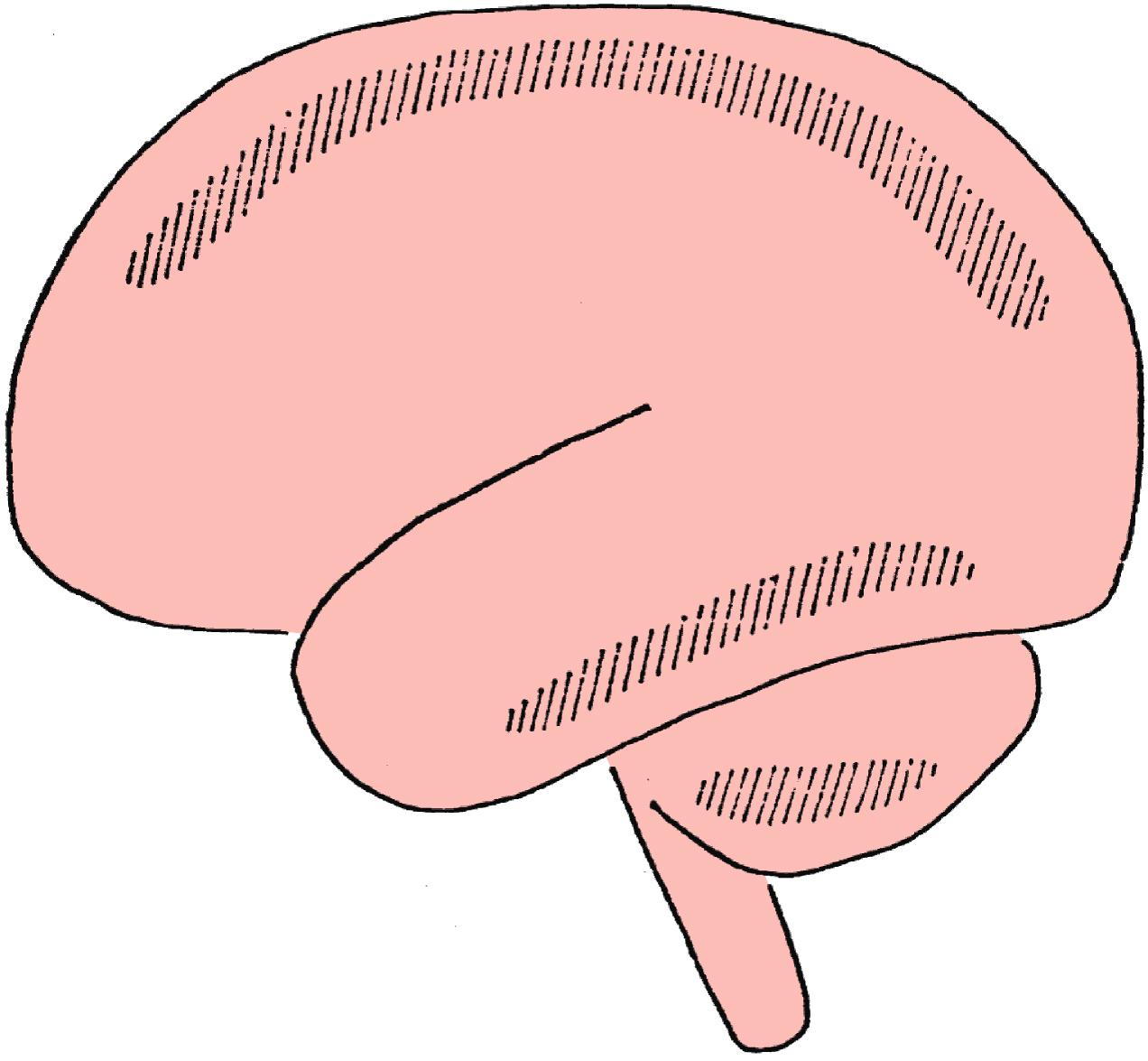 Figure 31.1, Hatched areas showing the most frequent locations of boundary area, or watershed zone infarcts in the brain, situated between the territories of major cerebral or cerebellar arteries.