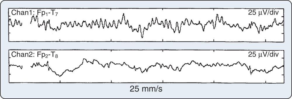 Fig. 12.4, The importance of electroencephalographic (EEG) baseline recording. This two-channel EEG recording was made immediately after induction of anesthesia, before head repositioning for insertion of a central venous catheter. Anesthetic induction apparently uncovered a preexisting asymmetry that was not evident in the waking electroencephalogram. Although the patient had a history of an earlier mild cerebrovascular accident and transient ischemic attacks, he appeared neurologically normal at preoperative assessment.