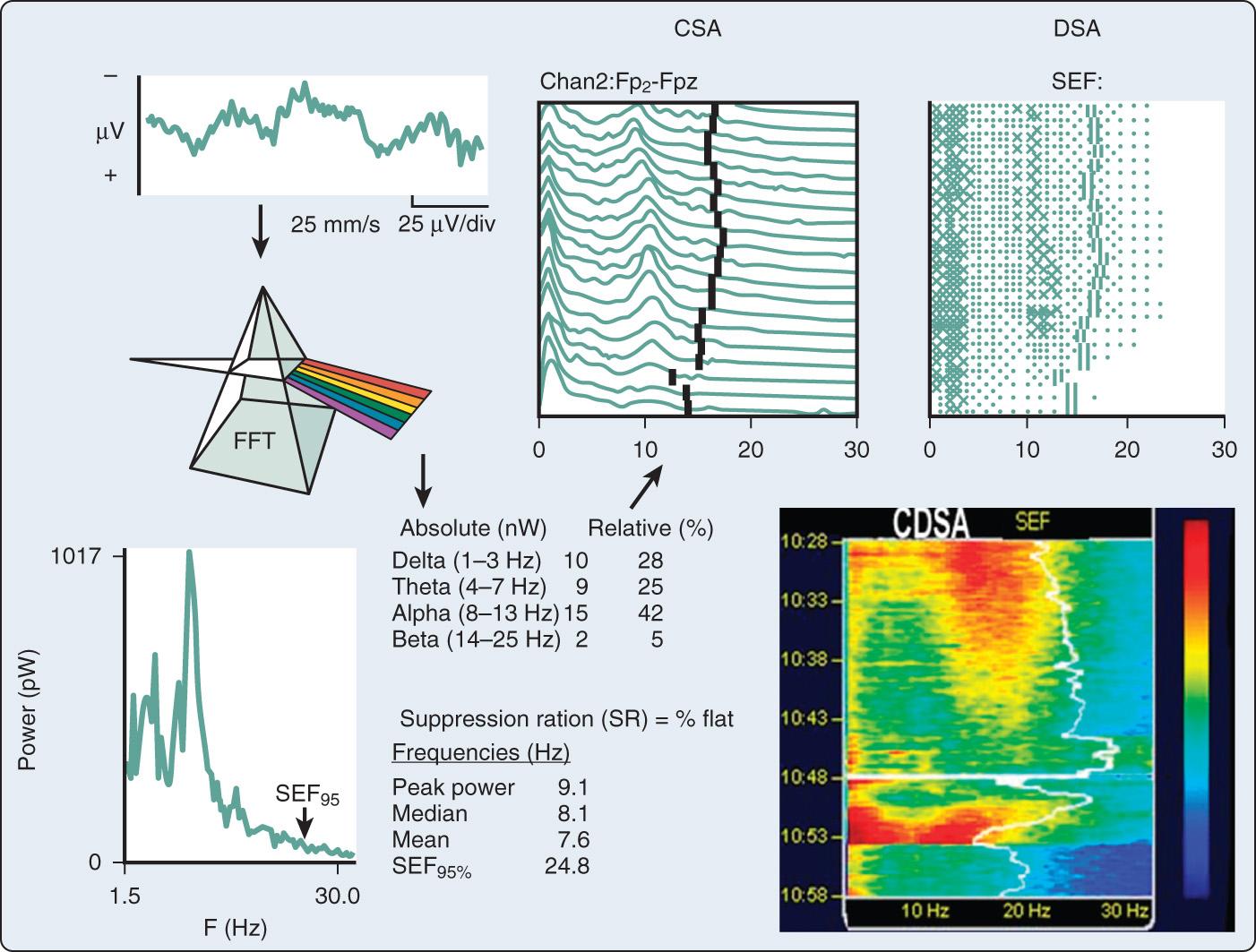 Fig. 12.6, Comparison of time- and frequency-domain electroencephalographic (EEG) displays. The traditional analog EEG signal shown in the upper left is a time-domain graph of scalp-recorded amplitude (µV) as a function of time. Digitized EEG segments (epochs) are computer-processed using the fast Fourier transform (FFT), which, like a prism, decomposes a complex electromagnetic signal into a series of sinusoids, each with a discrete frequency. The instantaneous relationship is then graphically depicted by the power spectrum (lower left), a frequency–domain plot of power ( µV 2 or pW ) as a function of frequency. The spectral edge frequency (SEF) defines the signal amplitude upper boundary. The three-dimensional compressed spectral array (CSA) plots successive power spectra with time on the z -axis (upper middle). The density-modulated spectral array (DSA; upper right ) improves data compression by using dot density to represent signal amplitude (ie, power). Amplitude resolution is improved through color coding in the color density spectral array (CDSA) shown at the lower right. The SEF is shown as the white vertical line. Note the EEG suppression at the bottom of each spectral trend.