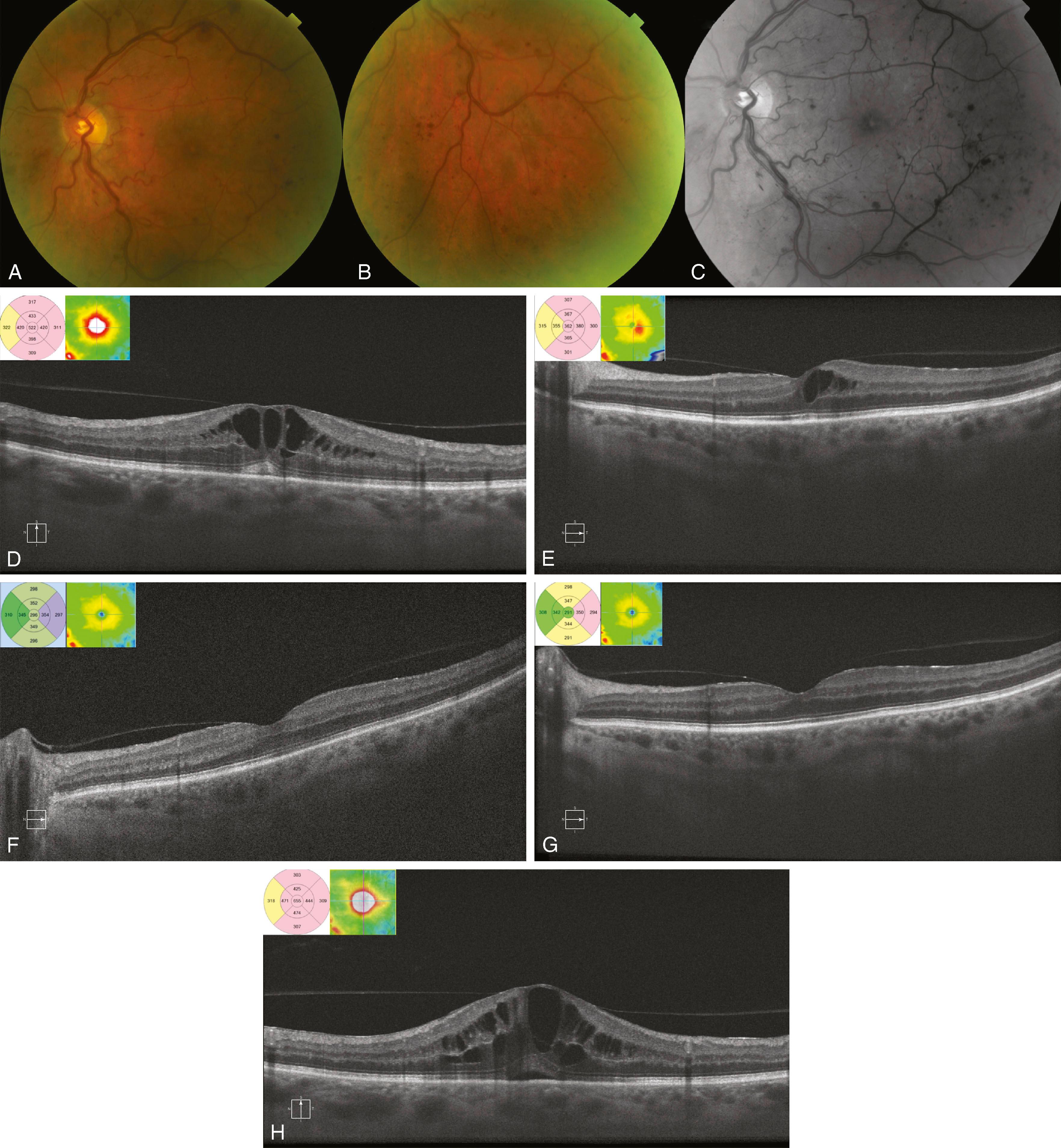central retinal vein occlusion with retinal neovascularization icd 10