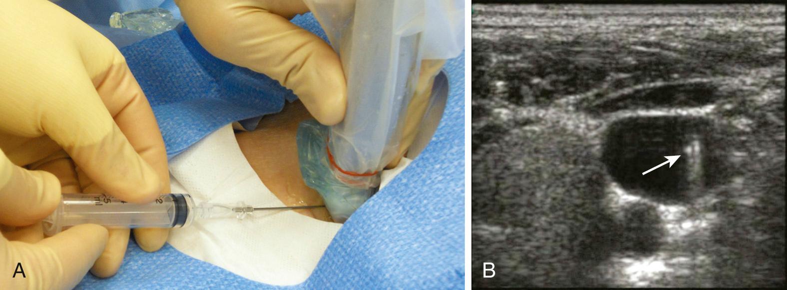 Figure 22.10, A, Ultrasound-guided insertion of the introducer needle. B, Cross-sectional ultrasound image of the needle (arrow) within the vessel.
