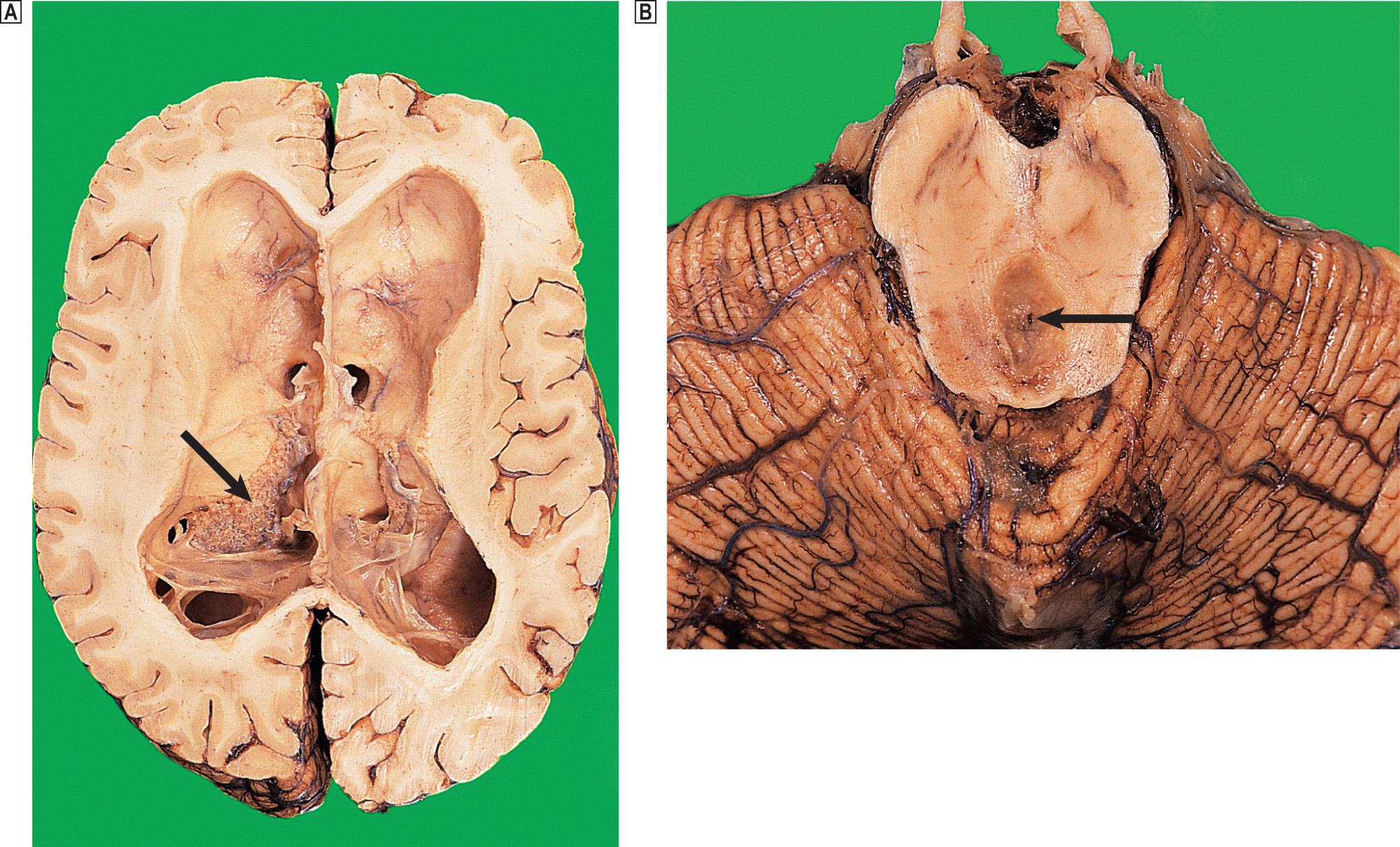 Fig. 26.10, Long-standing hydrocephalus.