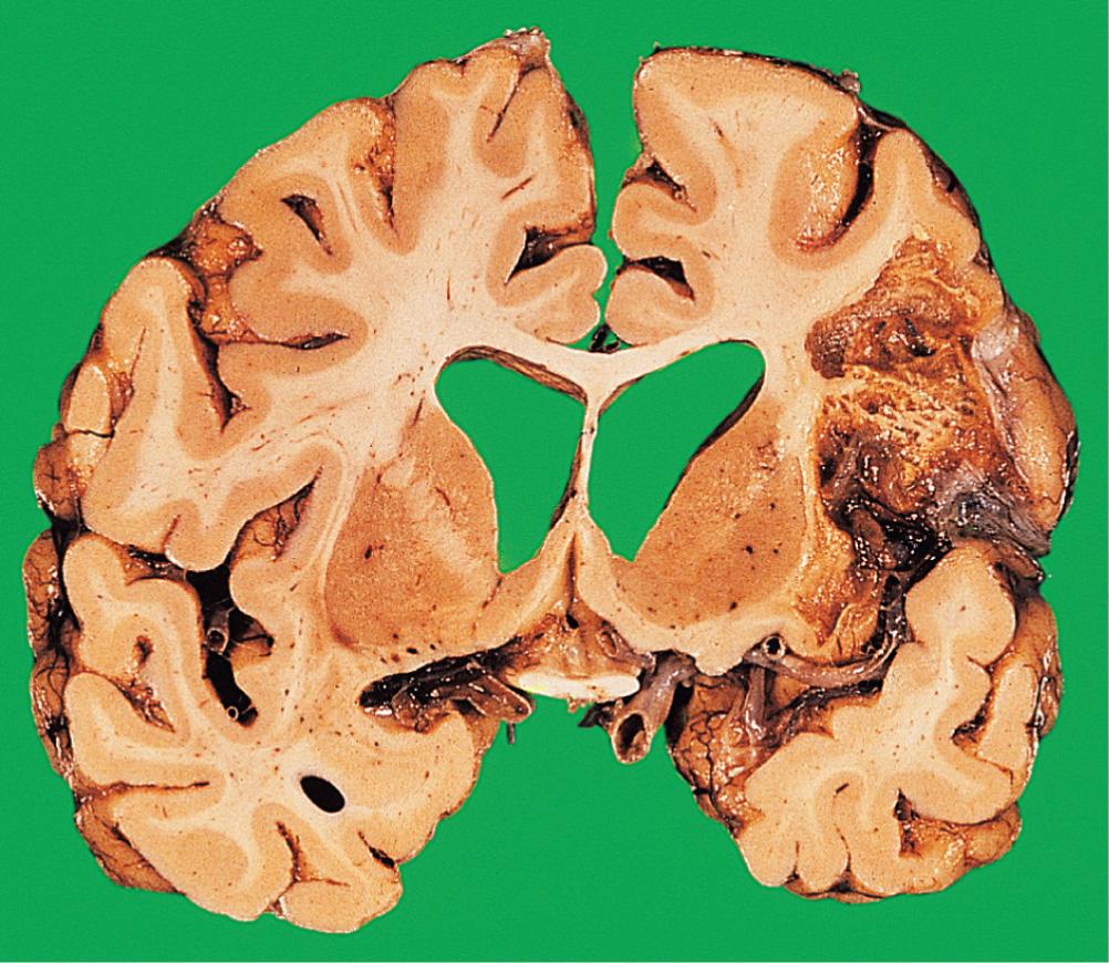 Fig. 26.11, Cerebral infarct: cystic change.