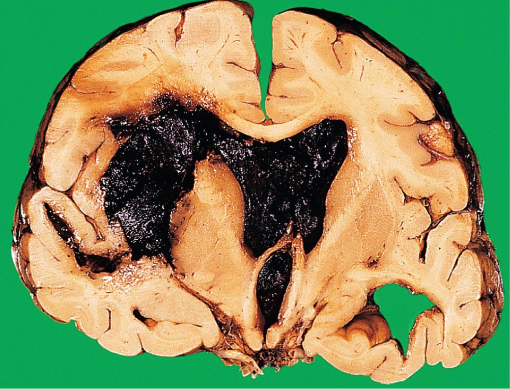 Fig. 26.12, Complications of intracerebral haemorrhage.