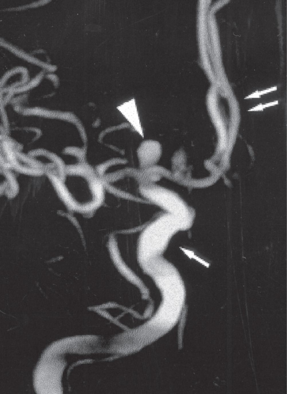 Fig. 26.13, Demonstration of a saccular aneurysm in vivo.