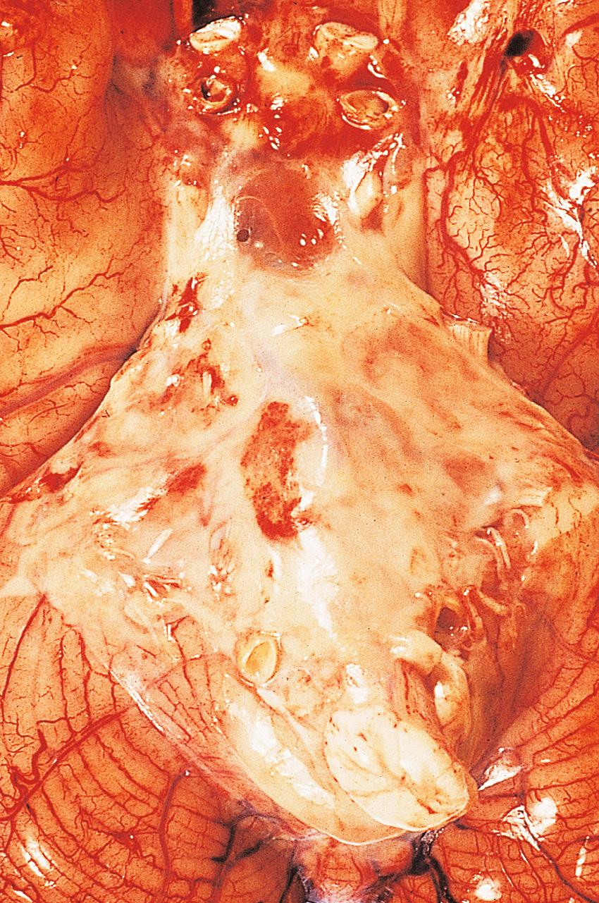 Fig. 26.14, Bacterial meningitis: basal exudate.