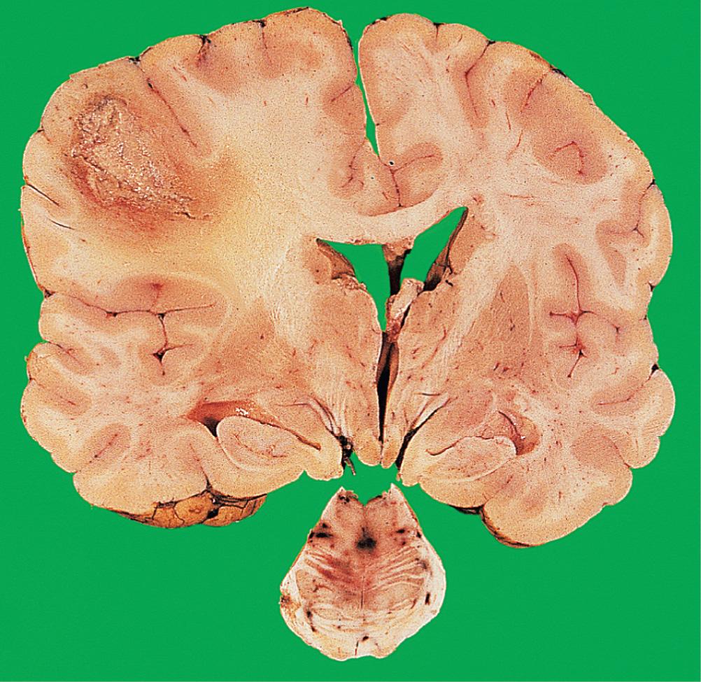 Fig. 26.15, Cerebral abscess: space-occupying lesion.