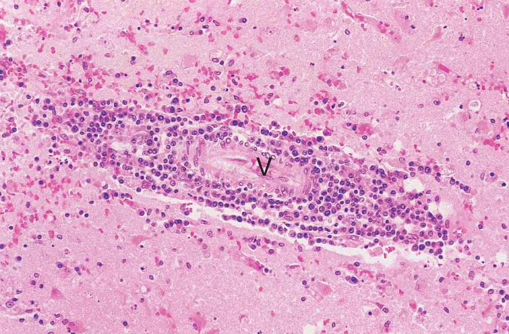 Fig. 26.16, Acute viral encephalitis due to herpes simplex virus.