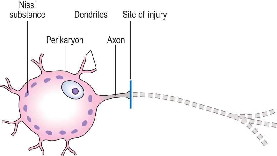 Fig. 26.4, Response to axonal injury: central chromatolysis and anterograde degeneration.