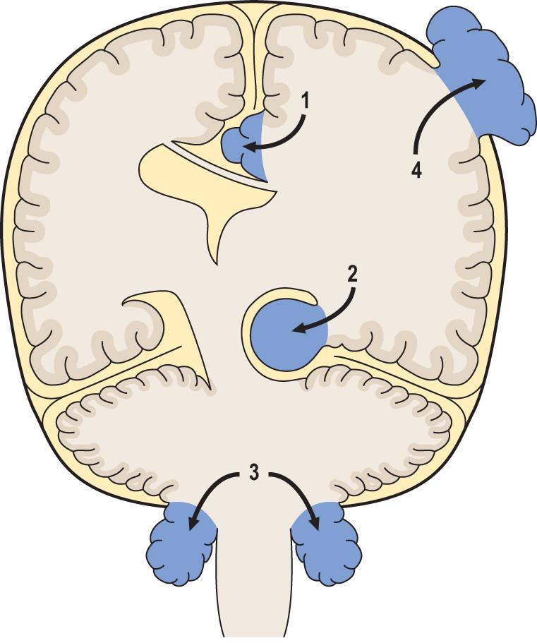 Fig. 26.5, Sites of intracranial herniation.