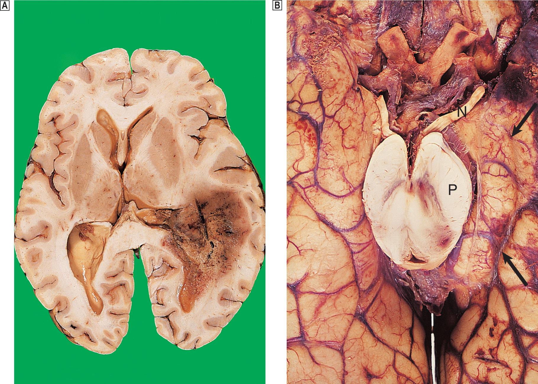 Fig. 26.6, Herniation effects in the brain.