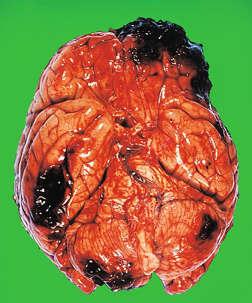 Fig. 26.7, Head injury: contusions and haematomas.