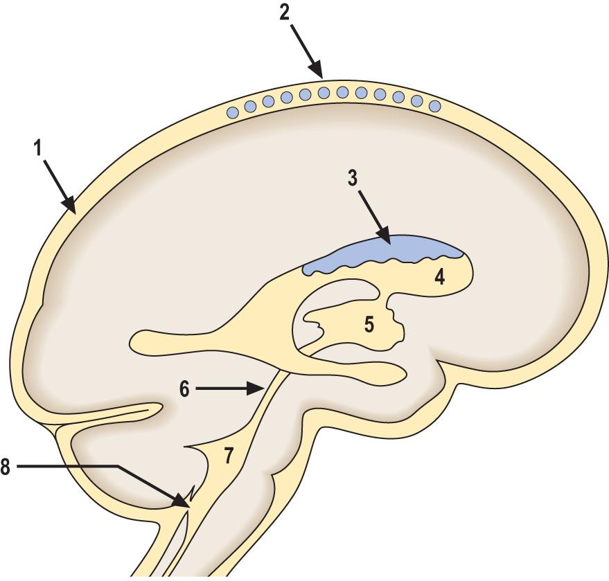 Fig. 26.9, Sites of obstruction in the cerebrospinal fluid (CSF) pathway.