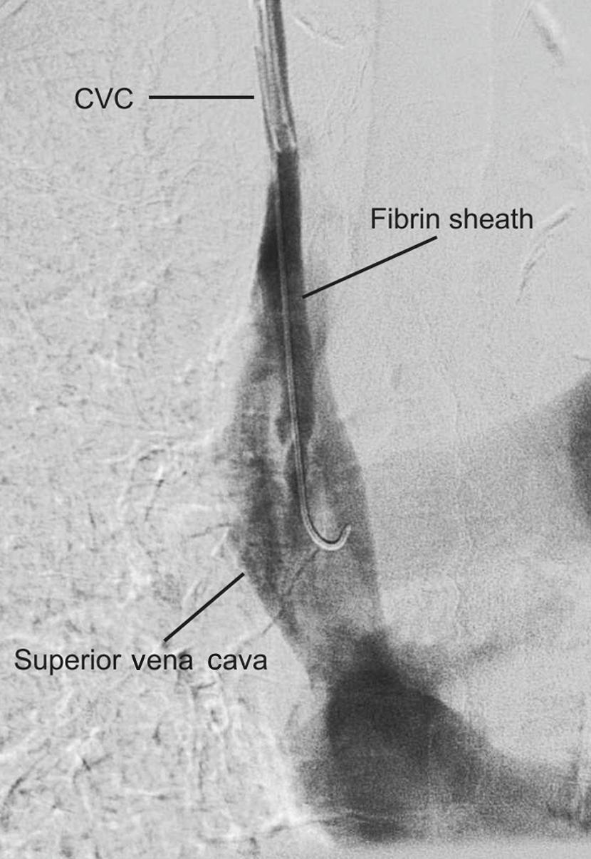 Figure 16.1, A venogram showing fibrin sheath around a partially withdrawn central venous catheter (CVC).