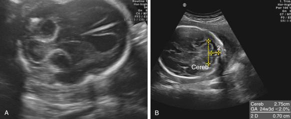 Fig. 37.2, (A) Rhombencephalosynapsis in a 21-week, 6-day fetus. The reduced size of the cerebellum is readily apparent. The cerebellum has a rounded shape, and there is a lack of hyperechogenicity in the midline owing to agenesis of the vermis. This fetus was referred because of severe ventriculomegaly with disruption of the septum pellucidum (not shown). (B) CH in a 28-week, 4-day fetus. TCD is 4 weeks smaller than expected, but the anatomy is conserved.