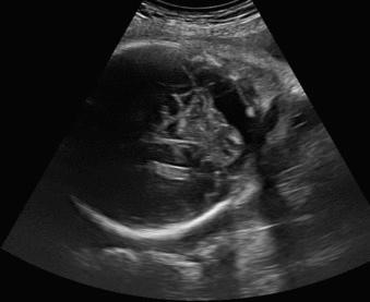 Fig. 37.3, Cerebellar asymmetry at 32 weeks' gestation after cerebellar hemorrhage.