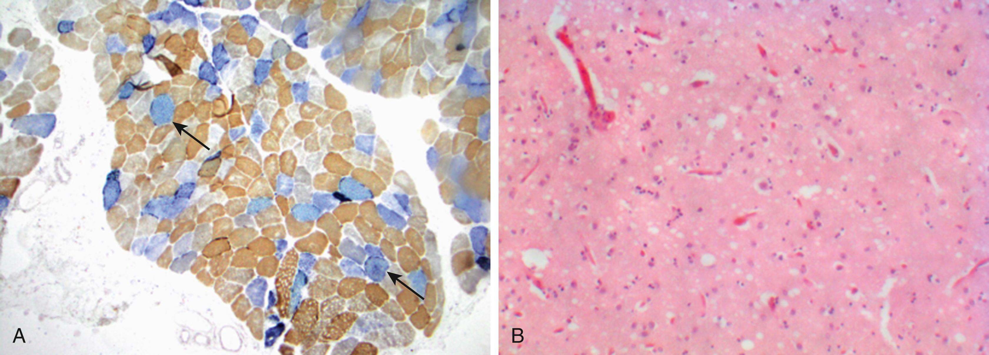 Fig. 23.3, Muscle biopsy demonstrates mitochondrial dysfunction in a patient with POLG -ataxia. Combined succinate dehydrogenase (SDH) (blue) and cytochrome c oxidase (COX) (brown) stain shows COX-negative fibers with strong SDH expression, indicating that these muscle fibers have respiratory chain defects with corresponding mitochondrial proliferation as a compensatory response ( arrows , A ). (Modified from Kuo et al., 2017 . Neurology 89, e1–e5.) Postmortem examination of the basal ganglia in a case of Creutzfeldt-Jakob disease demonstrates spongiform changes ( B ).