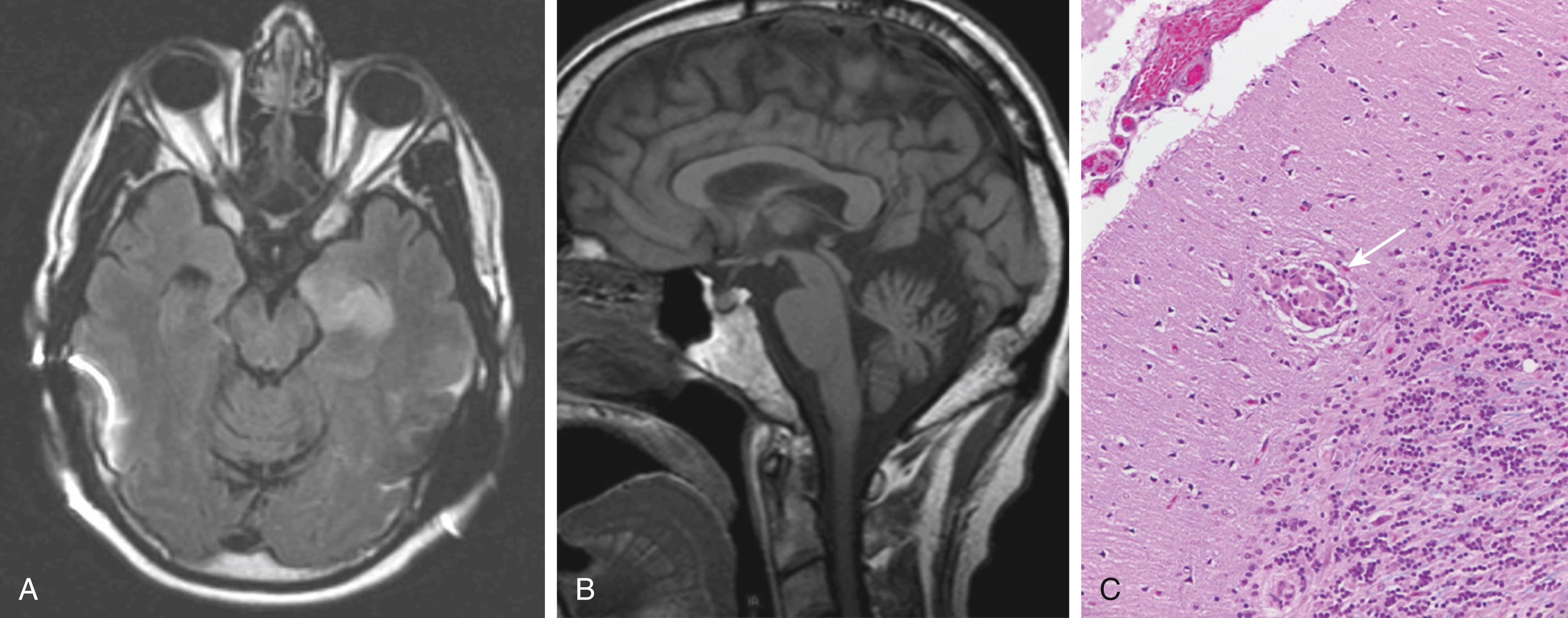 Fig. 23.4, A 51-year-old man with bilateral hearing loss and progressive ataxia. Brain magnetic resonance imaging (MRI) demonstrates hyperintensity in the left medial temporal region on an axial fluid-attenuated inversion recovery (FLAIR) sequence ( A ) and cerebellar atrophy on a sagittal T1 sequence ( B ). Postmortem examination shows the granuloma in the cerebellar cortex ( C ), confirming the diagnosis of neurosarcoidosis.