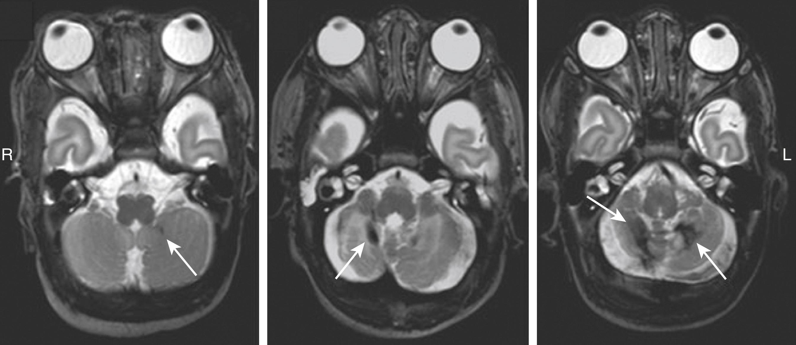 Fig. 129.4, Cerebellar hemorrhages. Cerebellar hemorrhage can be divided into different patterns: focal, small multiple punctate lesions, larger hemorrhagic lesion in one cerebellar hemisphere, or large bilateral cerebellar hemorrhages. White arrows indicate the cerebellar lesions.