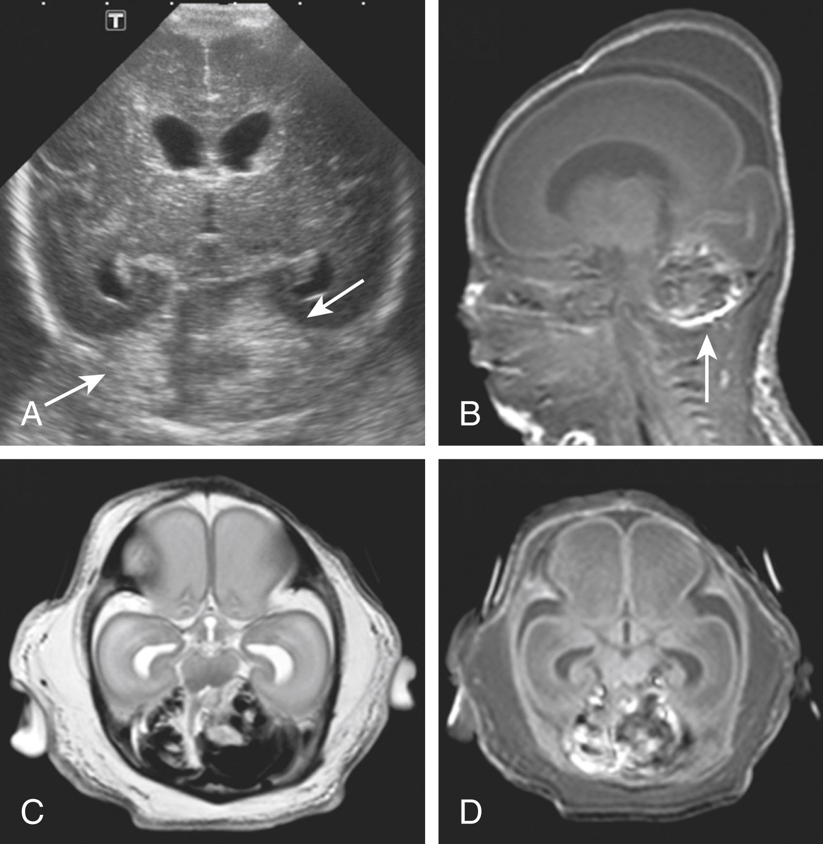 Fig. 129.5, Ventricular dilatation in combination with cerebellar hemorrhage. Baby girl, 24 weeks. Cranial ultrasound: a large bilateral cerebellar hemorrhage (arrows) : (A) Magnetic resonance imaging a few days later confirmed cerebellar hemorrhage (arrow) ; illustrated on a sagittal T1 (B), axial T2 (C), and axial T1 (D) images. The cerebellar structure has been completely destroyed by the hemorrhages. Ventricular dilatation was probably caused by obstruction of the cerebral spinal fluid circulation around the level of the fourth ventricle and aqueduct because minimal amount of intraventricular blood was visible.