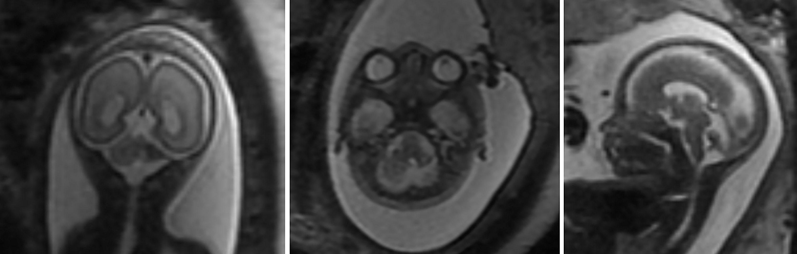 Fig. 27.1, Coronal (left) , axial (middle) , and sagittal (right) magnetic resonance images in fetus (24 weeks 2 days) with unilateral left cerebellar hemorrhage.