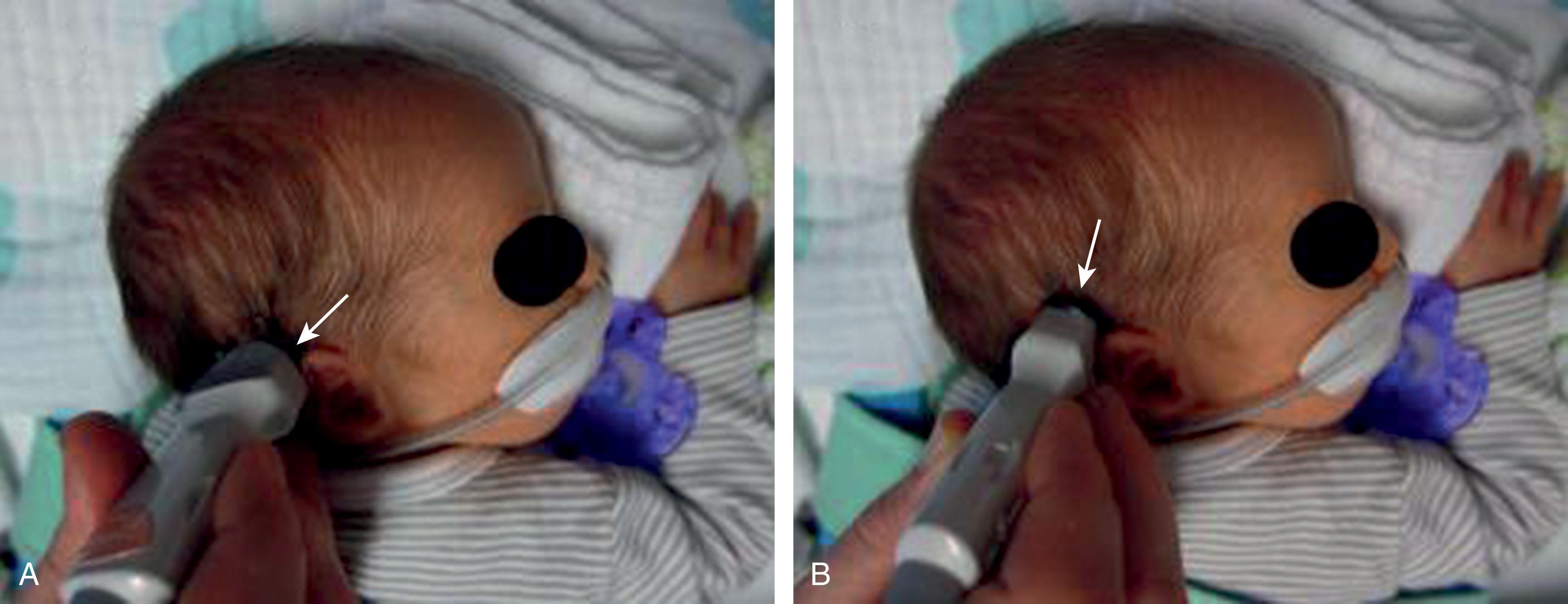Fig. 27.2, Probe positioning for mastoid fontanel cranial ultrasonography, axial (A) and coronal (B) views.