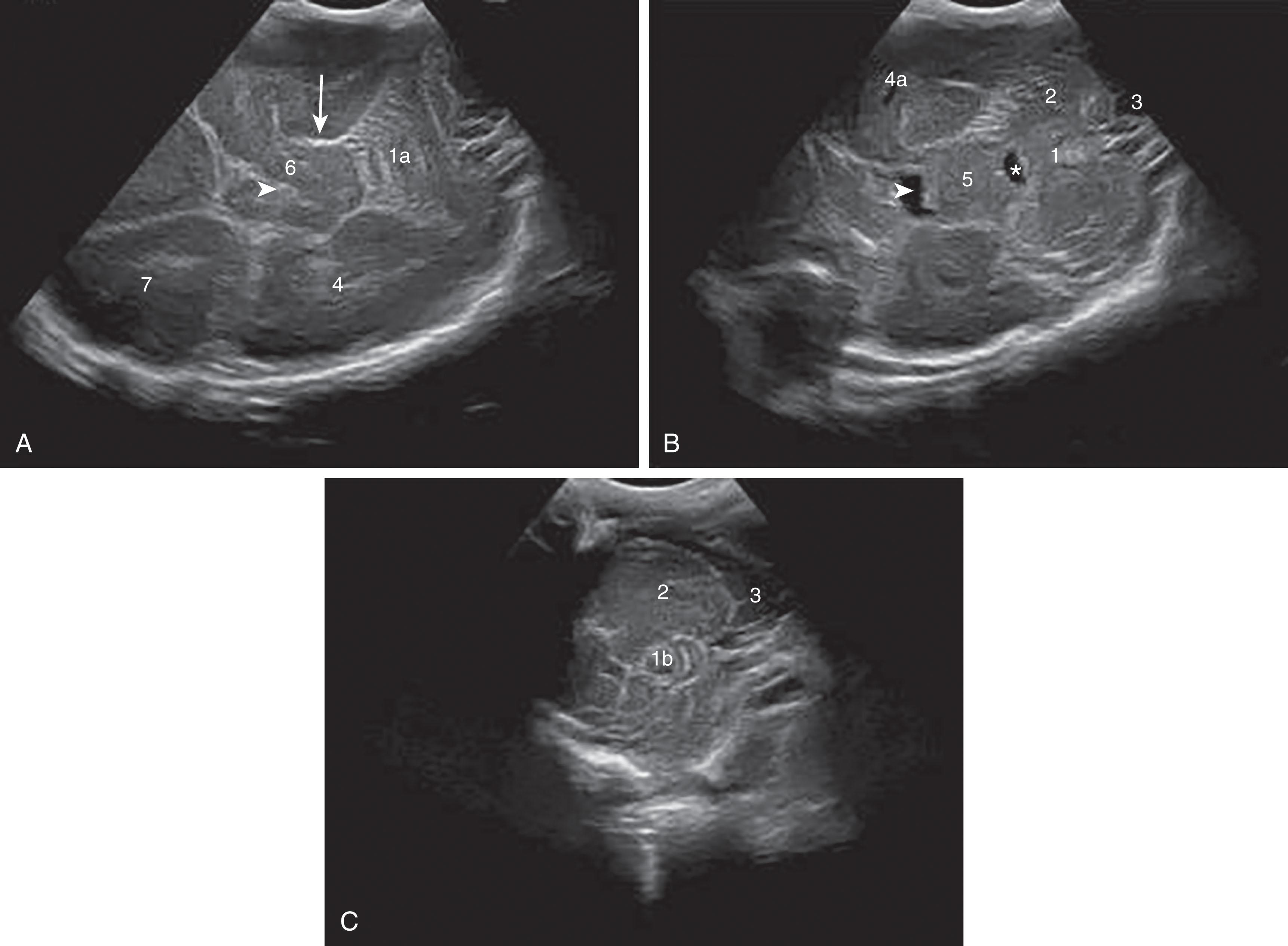 Fig. 27.3, Normal superior (A), middle (B), and inferior (C) axial views using the mastoid fontanel as an acoustic window in a preterm infant (gestational age 28 weeks), showing cerebellar vermis (1) with superior (1a) and inferior (1b) part, cerebellar hemisphere (2) , cisterna magna (3) , temporal lobe (4) , temporal horn (4a) , pons (5) , cerebral peduncle (6) , frontal lobe (7) , fourth ventricle (asterisk) , perimesencephalic cistern (arrow) , interpeduncular fossa (short arrow) , and prepontine cistern (arrowhead) .