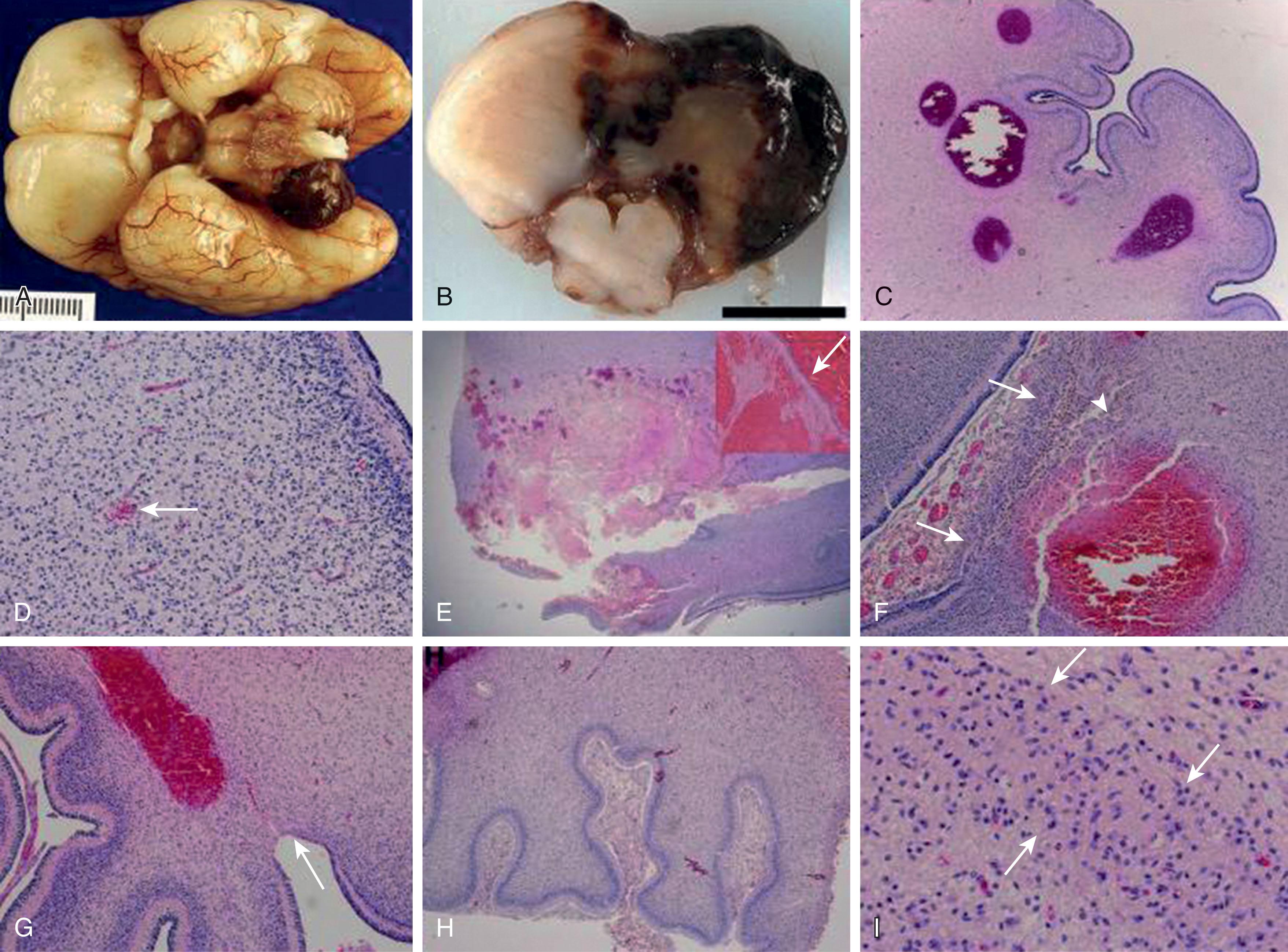 Fig. 27.4, Neuropathology of cerebellar hemorrhage. (A) Gross photograph of a 25-week-gestation infant with a large cerebellar hemorrhage involving the ventral surface. (B) Horizontal section through the cerebellum and rostral medulla of (A) showing multiple hemorrhages destroying cerebellar parenchyma. (C) Low-powered photomicrograph showing multiple recent hemorrhages at the interface of the emerging internal granule layer and the white matter. (D) Often small, relatively inconspicuous hemorrhages are noted near, or at a distance, from a large hemorrhage (arrow) . (E) Low-powered photomicrographs from a 28-week-gestation infant showing a large destructive hemorrhage. Inset photomicrograph of the hemorrhage at high power showing the remnants of the cortex (arrow) . Small hemorrhages (B to D) may enlarge and become confluent resulting in these large destructive lesions. Hemorrhage may extend into and disrupt the cortex (F) (arrows) , or there may be focal cerebellar cortical loss (arrow) associated with a nearby hemorrhage, suggesting that hemorrhages are associated with hypoxic–ischemic processes (G) (arrow) . Cerebellar hemorrhages frequently show a mixture of recent hemorrhages with more subacute changes, such as hemosiderin-laden macrophages (arrowhead) (F), suggesting that some larger lesions may be due to repeated bouts of hemorrhage. With longer survival periods, cerebellar hemorrhage is associated with cortical atrophy (H) as seen in this photomicrograph from a 1-month-old infant, born at 27 weeks. (I) High-powered photomicrograph of the cerebellar dentate (arrows) from the same case in (C) showing marked neuronal loss and gliosis. Bar = 1 cm in (B).