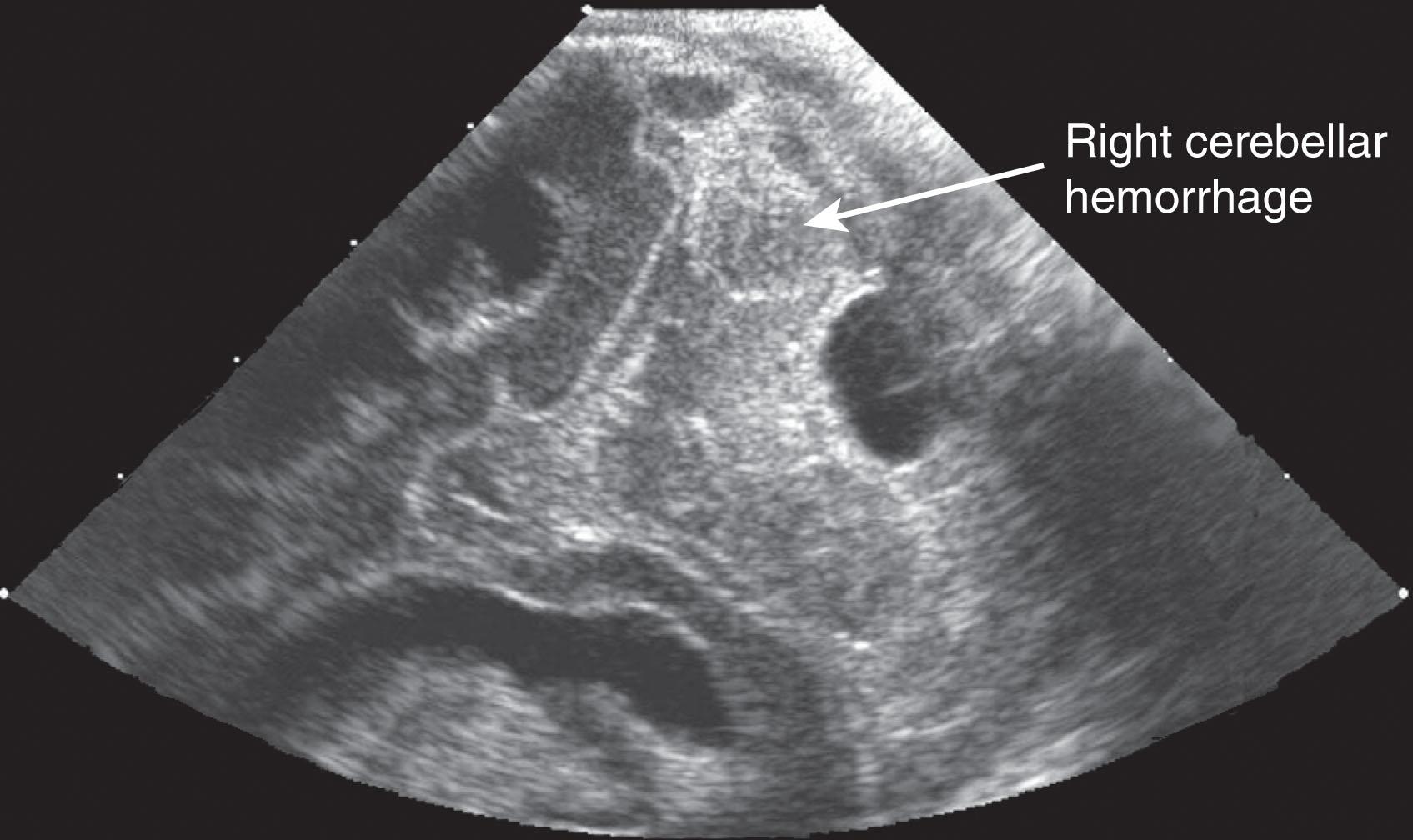 Fig. 27.5, Ultrasonography image of the posterior fossa obtained through the mastoid fontanelle depicts a right cerebellar hemorrhage.