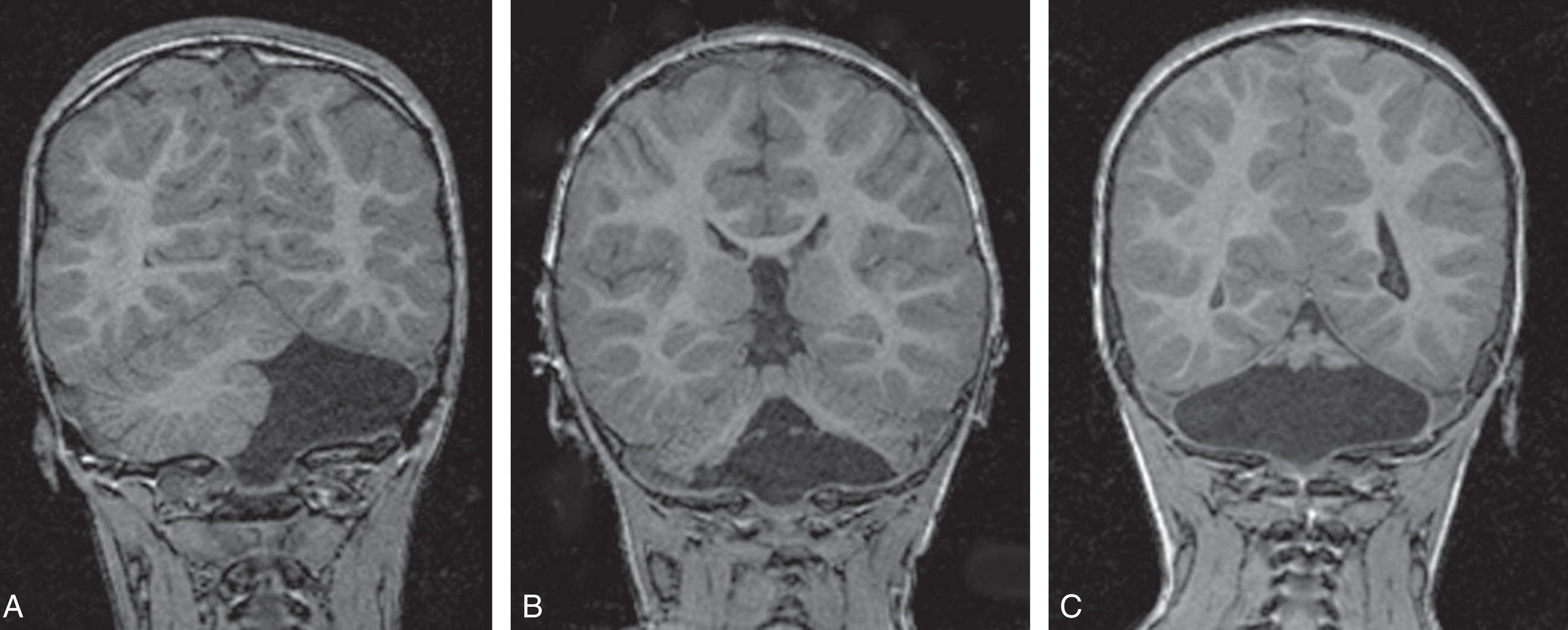 Fig. 27.8, Follow-up brain magnetic resonance image (coronal spoiled gradient recalled T1-weighted) of infants with isolated cerebellar hemorrhagic injury on neonatal cranial ultrasound. (A) Complete absence of the left cerebellar hemisphere with preservation of the right cerebellar hemisphere and vermis. (B) Absence of the inferior cerebellar vermis and inferior portions of both cerebellar hemispheres. (C) Near-total cerebellar destruction with only a small amount of superior cerebellar vermis present.